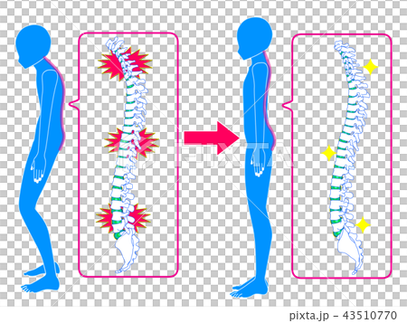 改善脊柱扭曲 改善脊柱扭曲 43510770