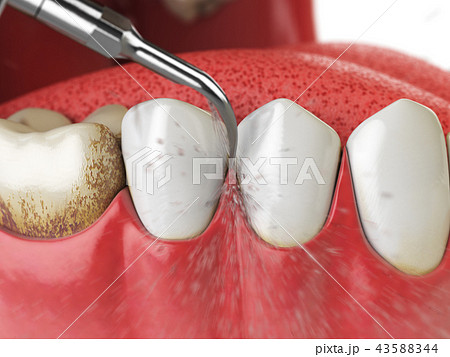 Professional teeth cleaning.  43588344