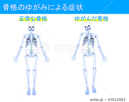 骨格のゆがみによる症状2 骨格のゆがみによる症状2 43622662