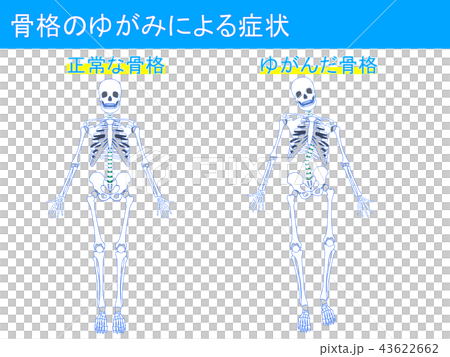 骨格のゆがみによる症状2 骨格のゆがみによる症状2 43622662
