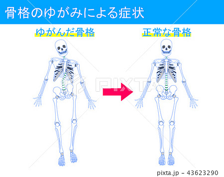 骨格のゆがみによる症状4 43623290