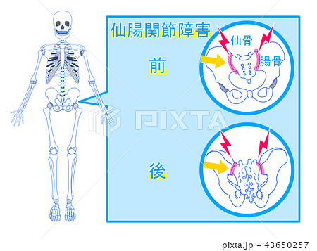 仙腸関節障害のイラスト素材