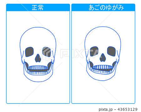 正常とあごのゆがみの比較2 43653129