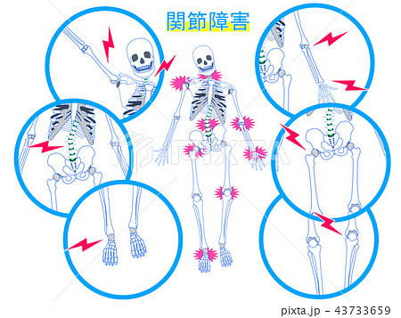 関節障害の説明図 関節障害の説明図 43733659