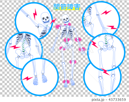 関節障害の説明図 関節障害の説明図 43733659