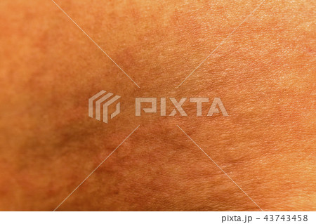 Blurred of skin human have red rash from allergies 43743458