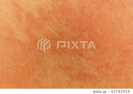 Blurred of skin human have red rash from allergies 43743459