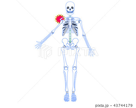 肩関節脱臼 43744179