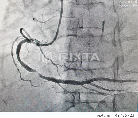 Coronary artery disease Coronary artery disease 43755723