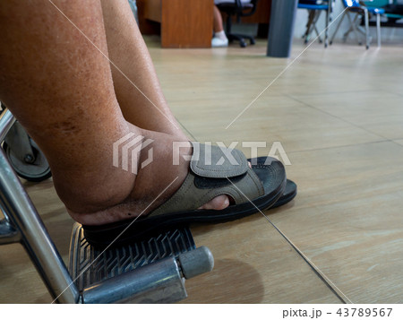 Men with diabetes and kidney disease With swelling Men with diabetes and kidney disease With swelling 43789567