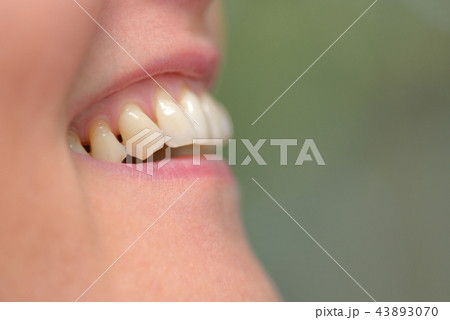Woman teeth parodontose Woman teeth parodontose 43893070