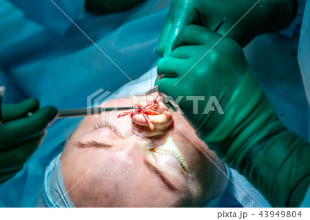 Surgeon and his assistant performing cosmetic surgery on nose in hospital operating room. Nose Surgeon and his assistant performing cosmetic surgery on nose in hospital operating room. Nose 43949804