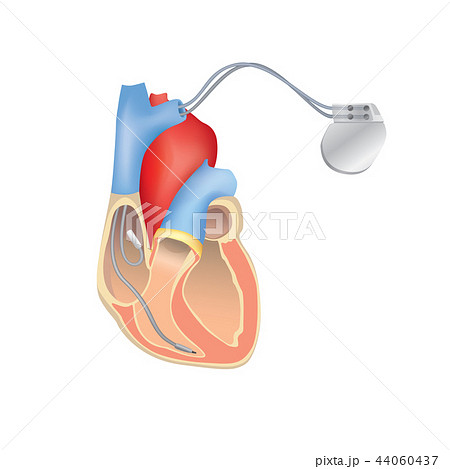Heart pacemaker in work. Heart anatomy with ICD Heart pacemaker in work. Heart anatomy with ICD 44060437