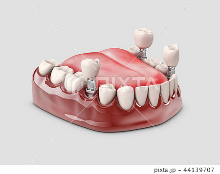 Human teeth and Dental implant. 3d illustration Human teeth and Dental implant. 3d illustration 44139707
