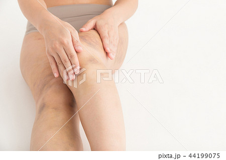 脂肪吸引・傷跡・女性(白バック) 44199075