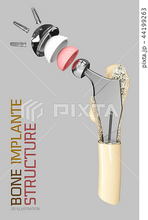 Hip joint structure, artificial joint 3d Illustration 44199263