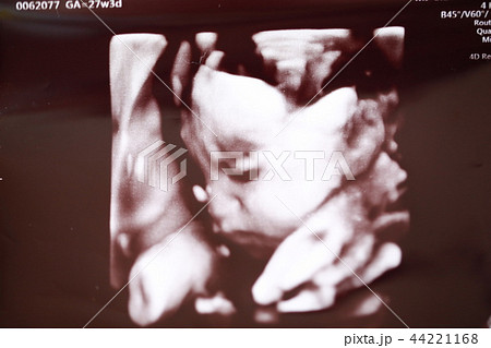 3Dエコー写真 3Dエコー写真 44221168