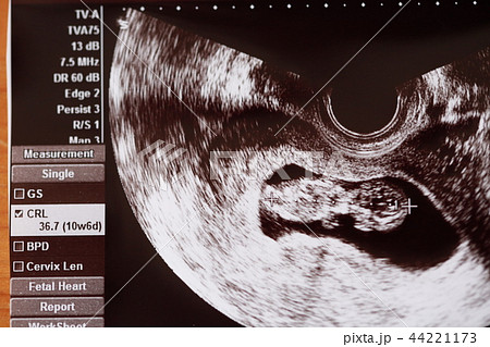 エコー写真 44221173