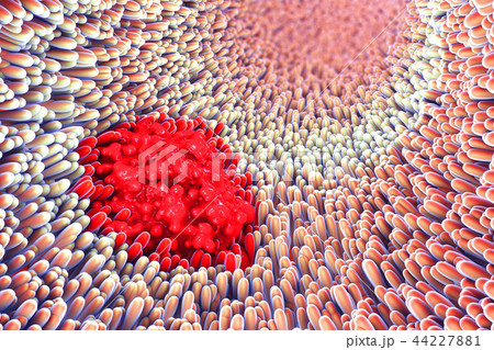 Microscopic closeup of intestine villus damage 44227881