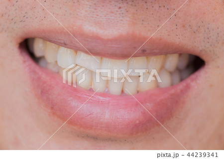 ugly smile dental problem. Teeth Injuries ugly smile dental problem. Teeth Injuries 44239341