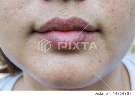 dry lips, Lack of skin lips maintenance 44254387