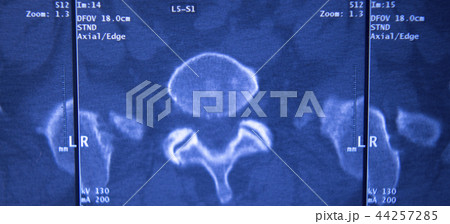 Medical hips spine pelvis MRI scan Medical hips spine pelvis MRI scan 44257285