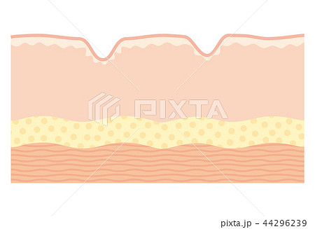 皮膚の断面図　シワ 44296239