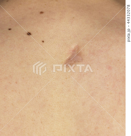 scar on the back of a man, close-up scar on the back of a man, close-up 44332078