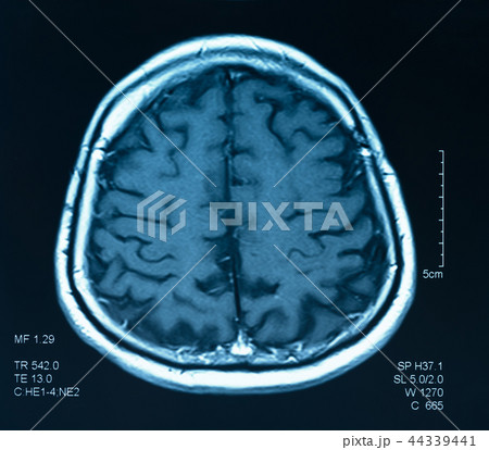 mri scan brain 44339441