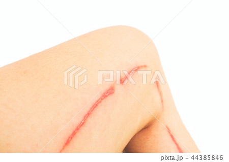 Blisters caused by rove beetles on leg. Isolated. Blisters caused by rove beetles on leg. Isolated. 44385846