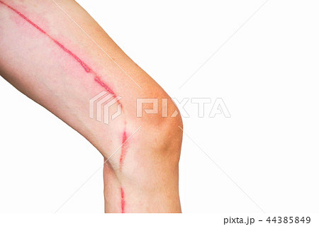 Blisters caused by rove beetles on leg. Isolated Blisters caused by rove beetles on leg. Isolated 44385849