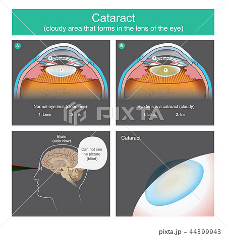 Cataract is a dense cloudy 44399943