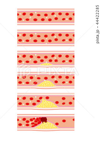 動脈硬化の血管の症状イメージのイラスト素材 44422285 Pixta