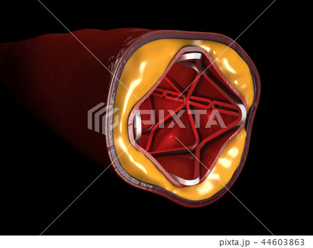 Heart Stent 3d Illustration 44603863