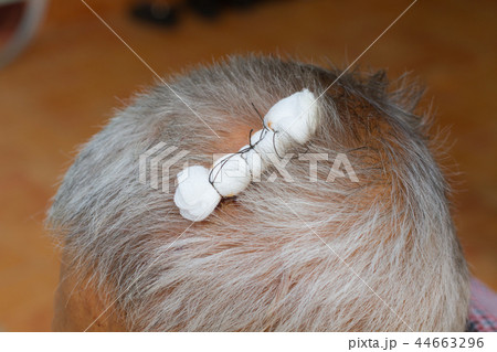 scalp of an old man with gauze scalp of an old man with gauze 44663296