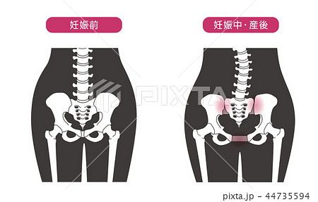 骨盤の緩み 腰部比較のイラスト素材