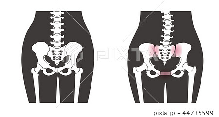 骨盤の緩み 腰部比較 44735599
