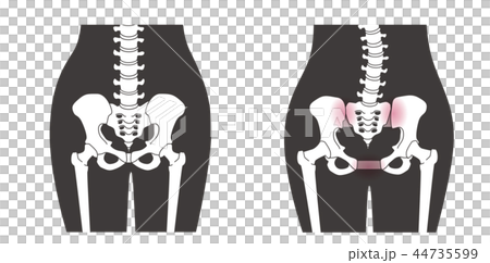骨盤の緩み 腰部比較 44735599