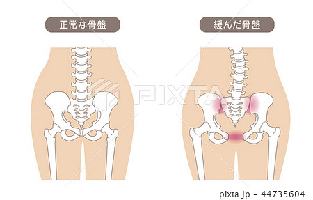 骨盤の緩み 腰部比較 骨盤の緩み 腰部比較 44735604