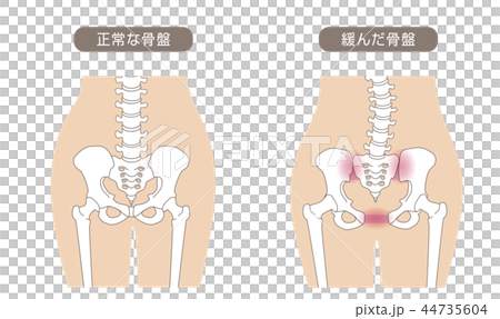 骨盤の緩み 腰部比較 骨盤の緩み 腰部比較 44735604