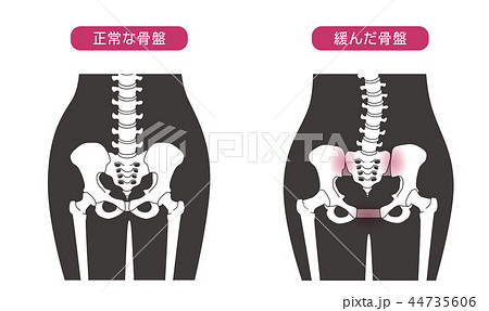 骨盤の緩み 腰部比較 44735606