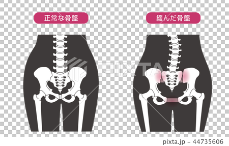 骨盤の緩み 腰部比較 44735606