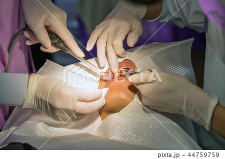 doctor cleaning teeth patient with ultrasonic tool 44759759