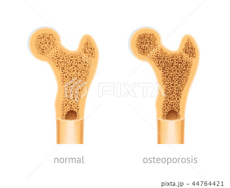 Healthy and osteoporosis human bone 44764421