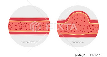 Healthy and sick aneurysm human vessel 44764428