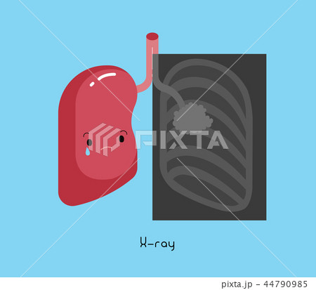 X-ray of human lung cancer, vector cartoon. X-ray of human lung cancer, vector cartoon. 44790985