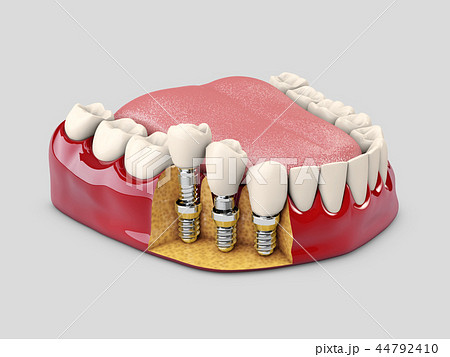 Human teeth and Dental implant. 3d illustration 44792410