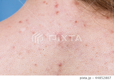 Closeup human skin with problem 44852807