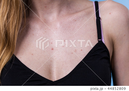 Woman having pimples red spots on chest 44852809