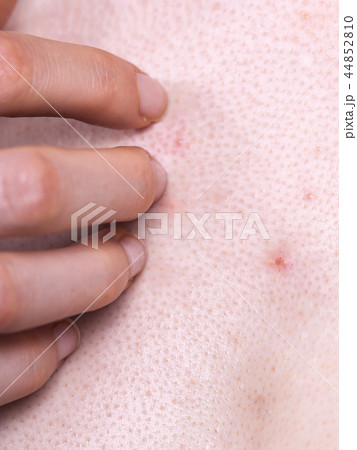 Woman dealing with pimples red spots 44852810